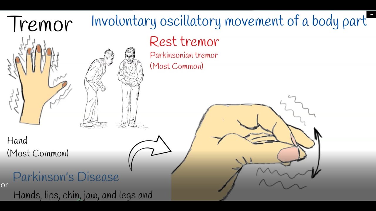 Why Do Hands Shake When Resting on a Table？ Common Causes and Solutions